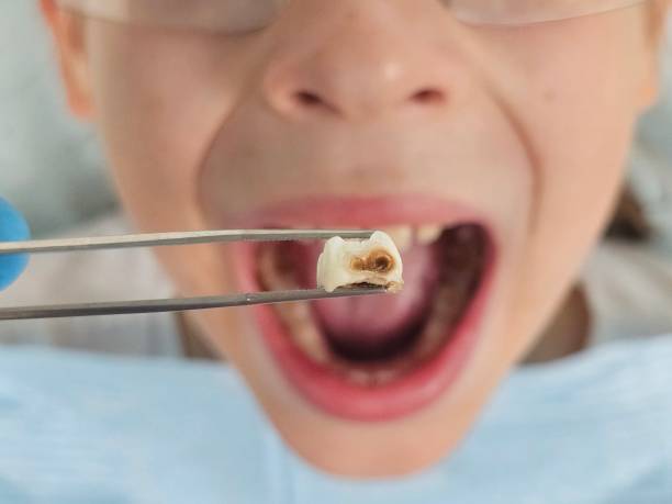 Best Emergency Dentist for Lost Fillings or Crowns in Sanger, TX